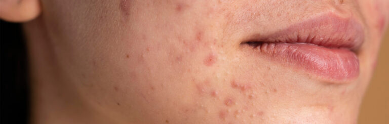 Tratamentos para acne: saiba como cuidar melhor da sua pele.