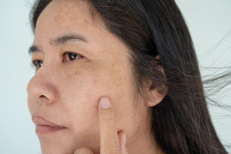 Tratamento de melasma com Handpico: tudo o que você precisa saber