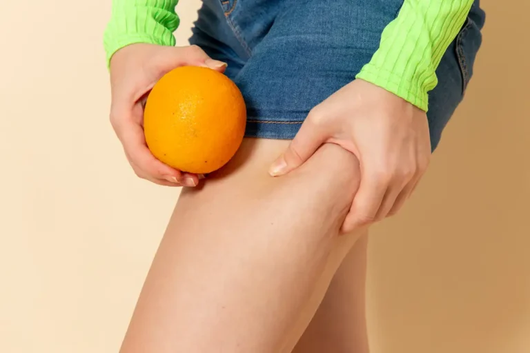 Celulite tem cura? Entenda e veja o que melhora
