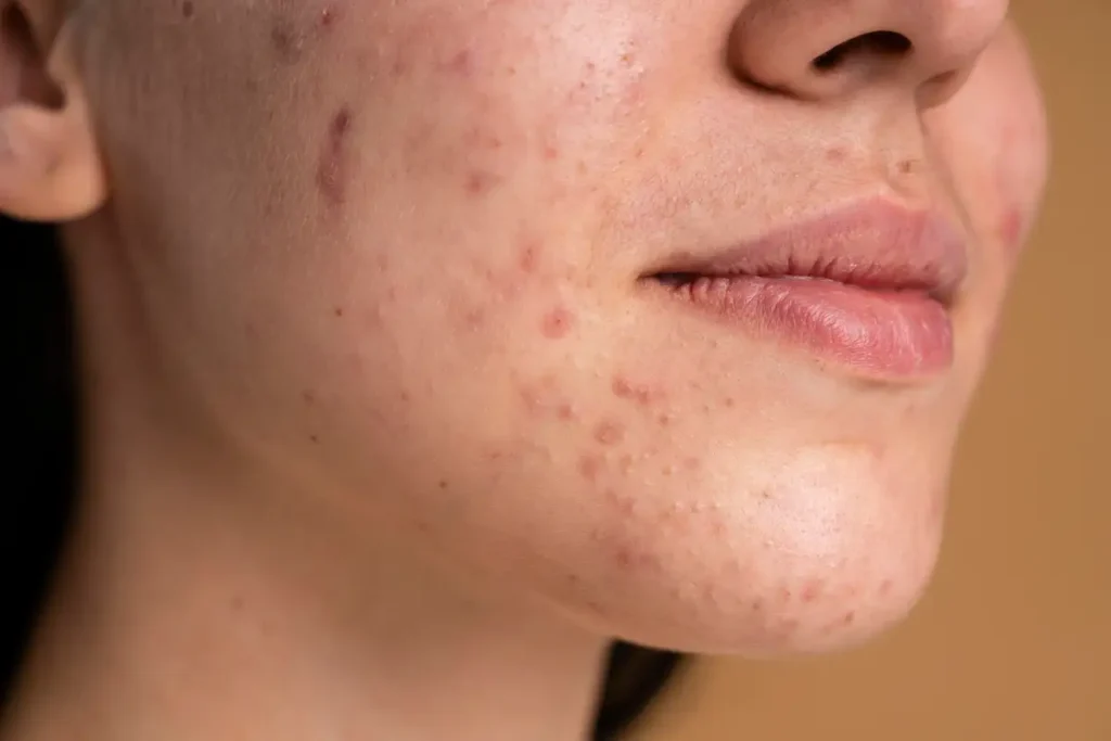 Cicatrizes de Acne: Laser CO2 Fracionado ou Microagulhamento Cicatrizes de acne: Laser CO2 fracionado ou microagulhamento