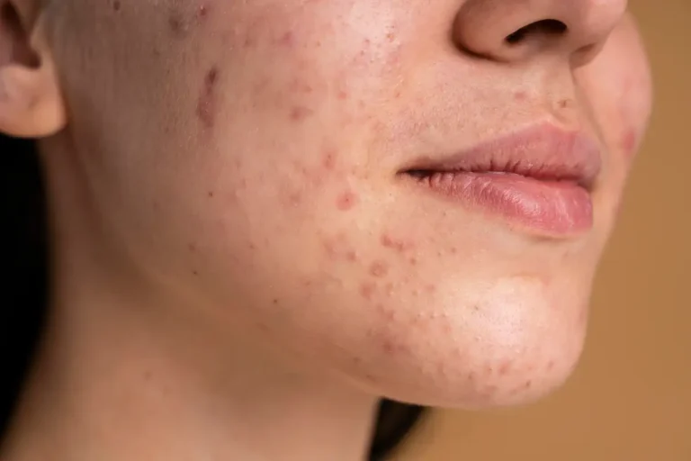 Cicatrizes de Acne: Laser CO2 Fracionado ou Microagulhamento