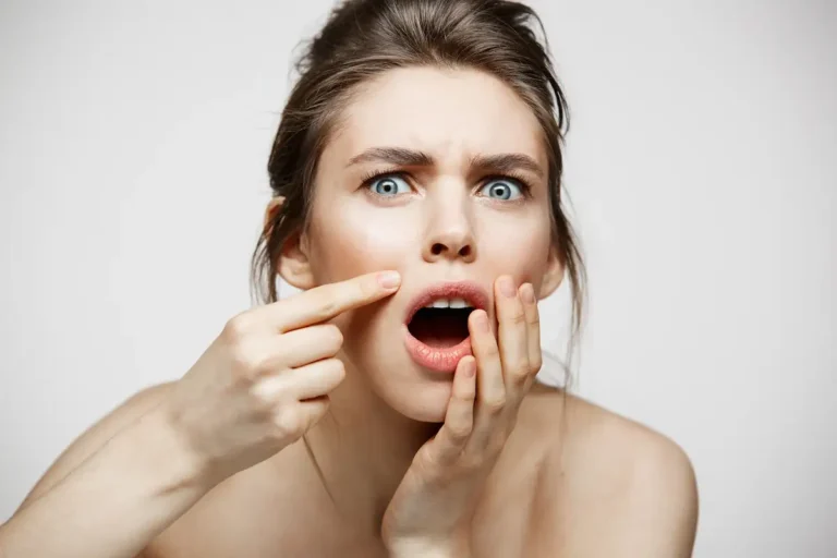 Como tratar acne na mulher adulta: o que funciona