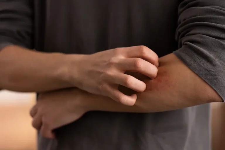 Dermatite atópica: como tratar em adultos e crianças