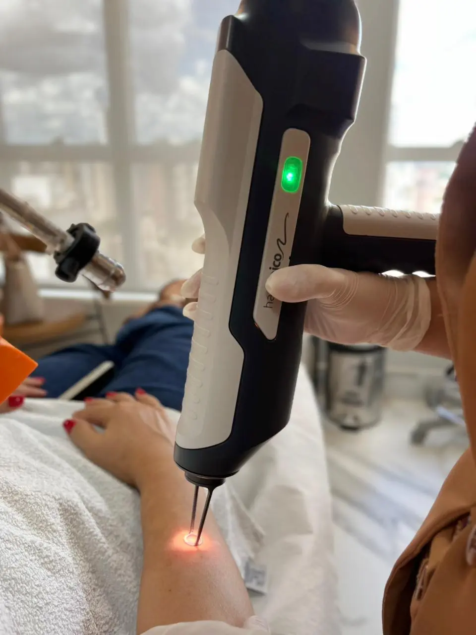 Laser de picossegundos HandPico em ação com feixe vermelho aplicado sobre a pele durante sessão de tratamento dermatológico