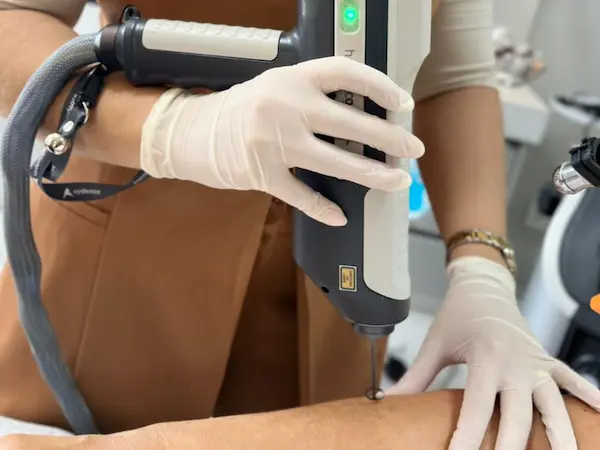 Laser de picossegundos HandPico em ação durante sessão de tratamento dermatológico