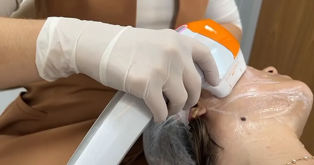 Ultraformer MPT dói? Quantas sessões são necessárias? Ultraformer MPT dói: aplicação do ultrassom microfocado no rosto, na clínica da Dra. Mariana Cabral em Goiânia
