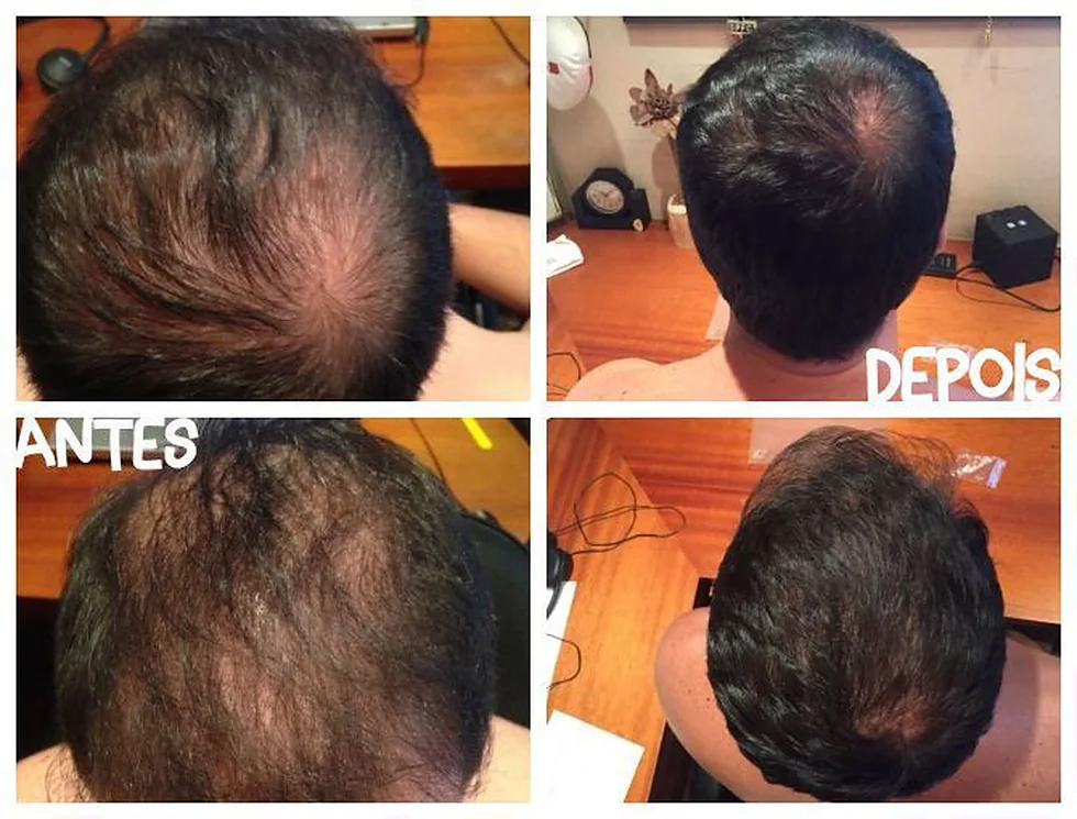 Antes e depois de paciente com alopecia androgenética tratada com MMP capilar, na coroa e na região occipital