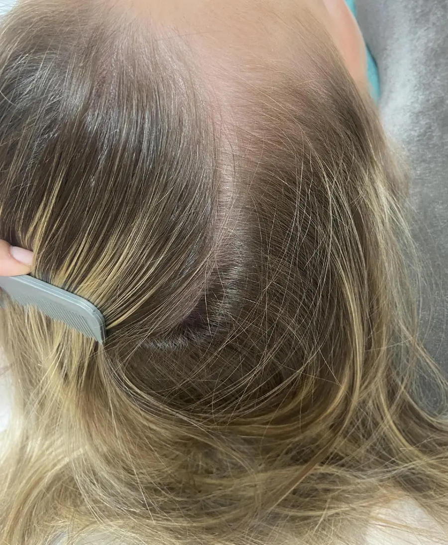 Linha frontal antes do tratamento para queda de cabelo por caneta emagrecedora, com rarefação visível