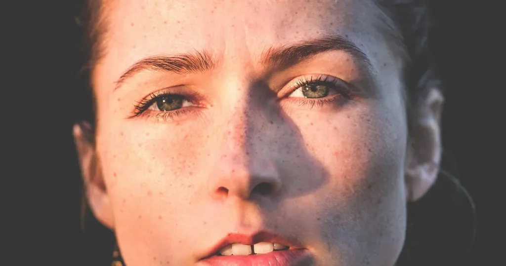 Laser para melasma pode piorar a mancha? Entenda o efeito rebote Laser para melasma e efeito rebote: rosto de mulher com manchas sob a luz do sol